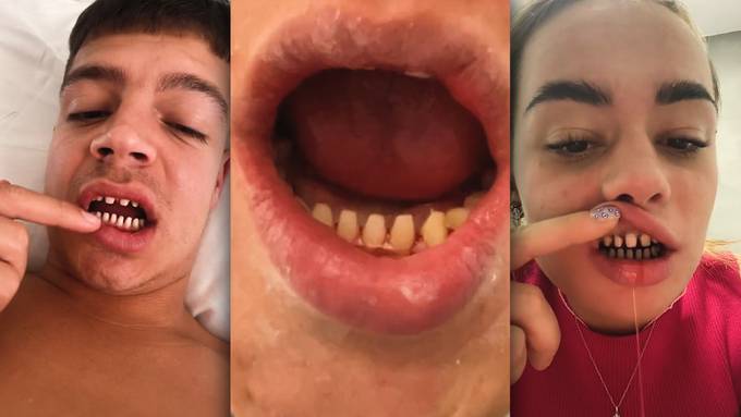 «Körperverletzung»: Expertin warnt vor türkischer Zahnbehandlung