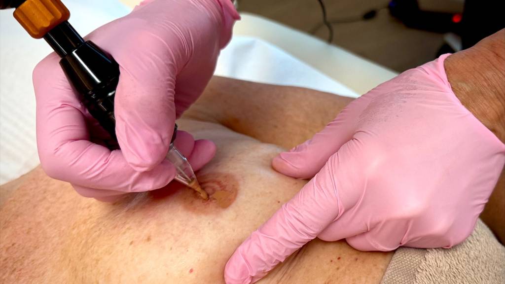 Brustwarzen-Tätowieren nach Krebsoperation