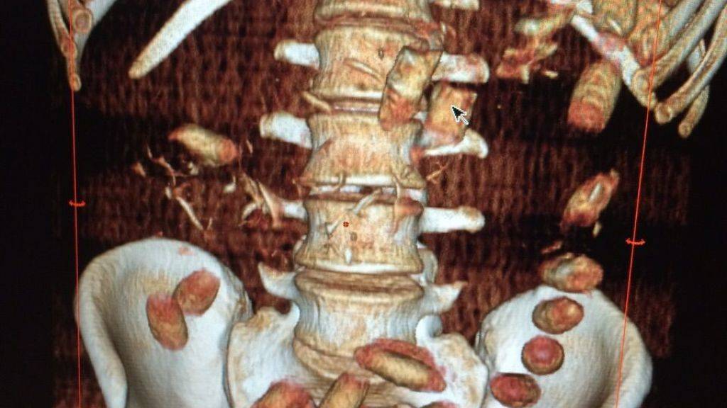 Eine Röntgenaufnahme zeigt, dass die Dealer zum Teil mehrere Dutzend Kokain-Fingerlinge im Magen-Darmtrakt transportierten. (Bild: Kapo VD)