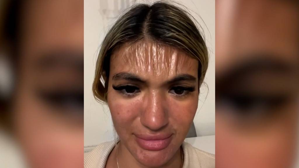Stirn wie Plastik: Britin zeigt bizarre Folgen eines Sonnenbrands