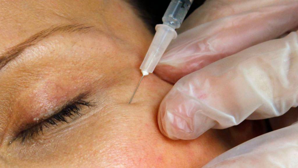 Zwei Frauen aus der Ukraine boten illegal Behandlungen mit Botox, Hyaluronfillern und Lasergeräten an. (Symbolbild)