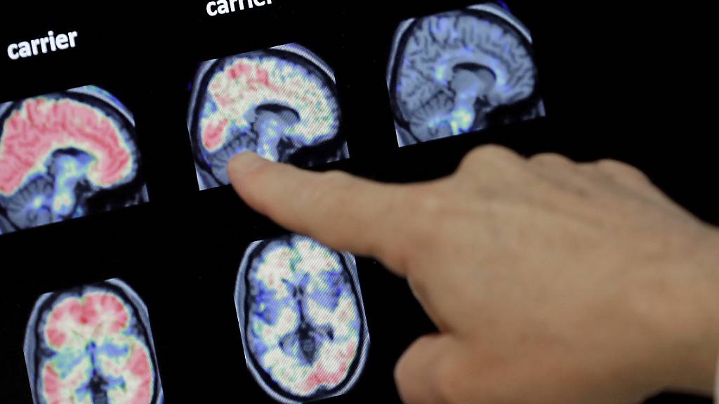 Ein Forschungsdurchbruch macht Hoffnung für die Behandlung von Alzheimer-Patienten. (Symbolbild)