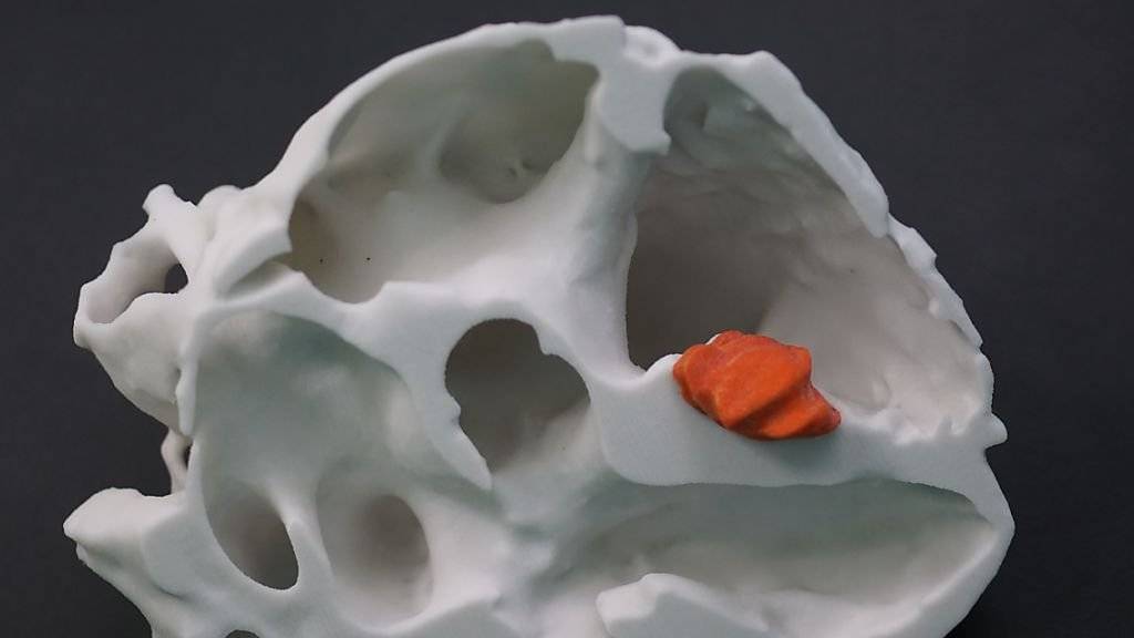 Das dreidimensionale Modell eines Herzens mitsamt dem Tumor hat in Basel eine komplizierte Herzoperation wesentlich erleichtert. Hergestellt wurde es mit einem 3D-Drucker.