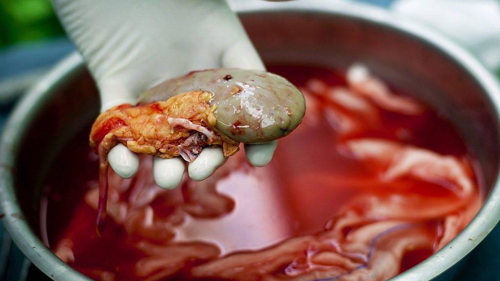 In Bulgarien ist ein illegaler Nieren-Händlerring aufgeflogen, der arme Menschen gegen Geld zur Organspende brachte. (Symbolbild)