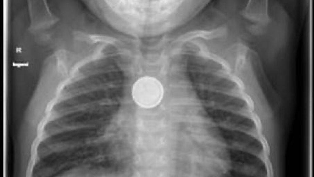 Kann verheerende Folgen haben: Verschluckte Knopfbatterie im Röntgenbild eines kleinen Kindes