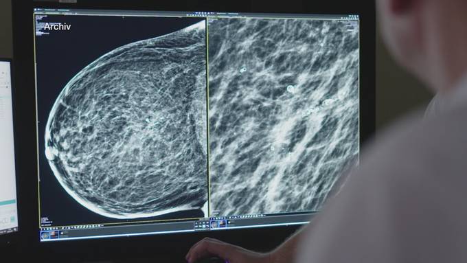 Früherkennung Brustkrebs