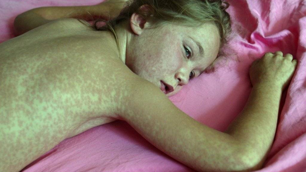 Ein siebenjähriges an Masern erkranktes Mädchen mit den typischen roten Flecken. (Archivbild)