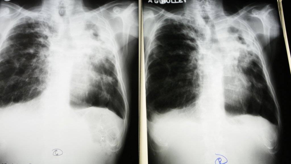 Röntgenaufnahme eines Tuberkulosepatienten: Bei mehreren Flüchtlingen aus Afrika hat das Institut für Medizinische Mikrobiologie der Universität Zürich im Jahr 2016 einen multiresistenten Tuberkulosekeim entdeckt. (Symbolbild)