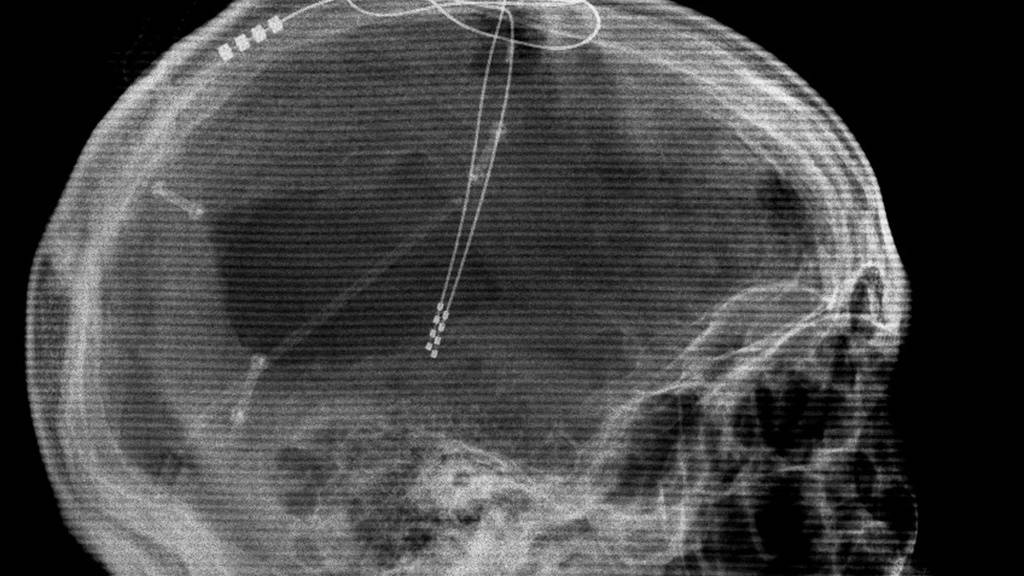 Röntgenbild eines Patienten mit implantierten Elektroden zur Tiefen Hirnstimulation (Deep Brain Stimulation DBS), einer Therapieform zur Linderung von Parkinson. Der Welt-Parkinson-Tag vom kommenden Sonntag erinnert daran, dass es jede/n treffen kann und dass Früherkennung wichtig ist. (Archivbild)