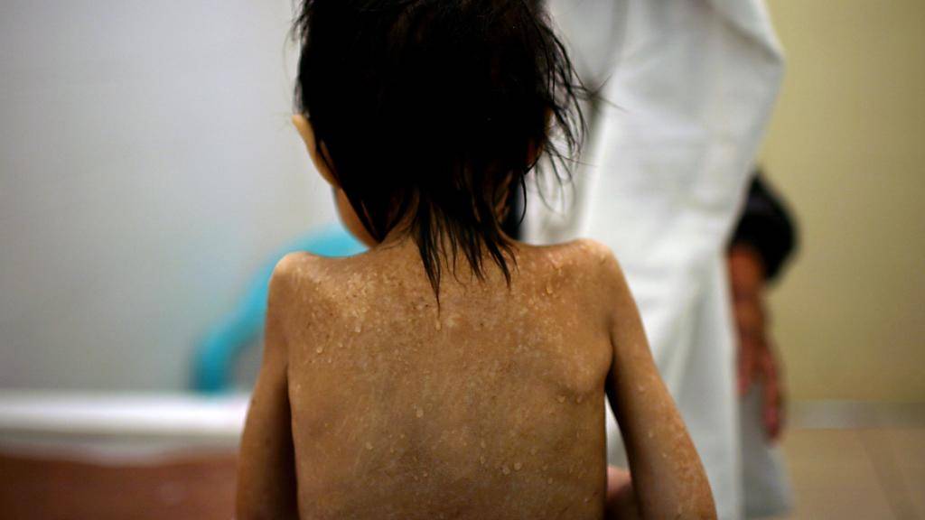 Ein Mädchen in Guatemala leidet an Unterernährung - fünf Prozent der Bevölkerung von Lateinamerika und der Karibik teilen dieses Schicksal. (Archiv)