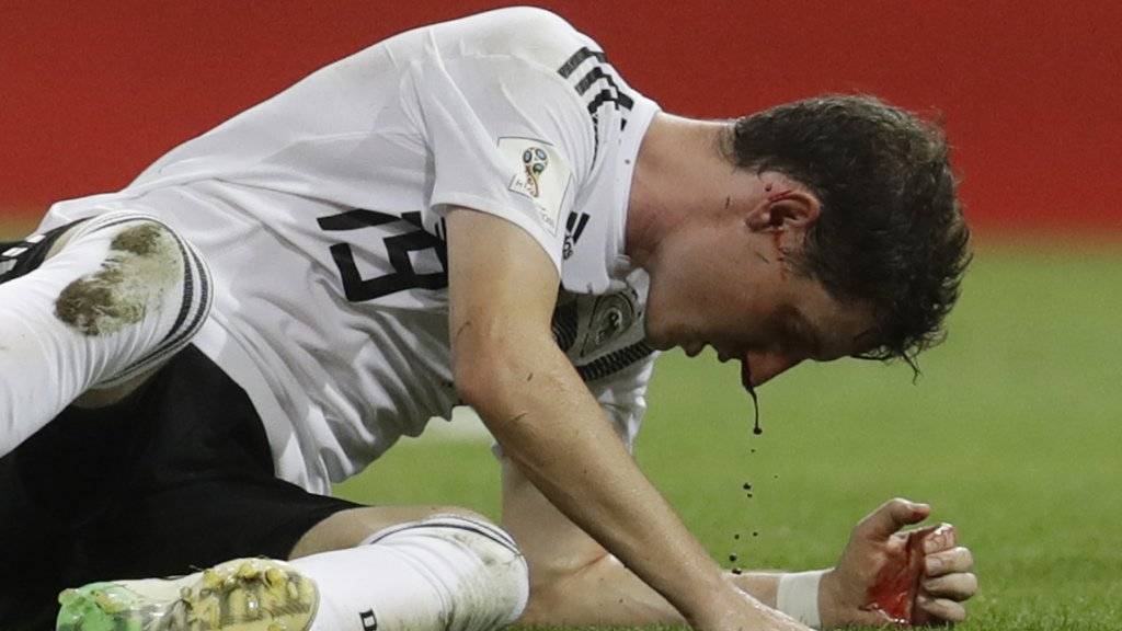 Blut tropft aus der Nase - Der Deutsche Sebastian Rudy brach sich beim 2:1 gegen Schweden die Nase