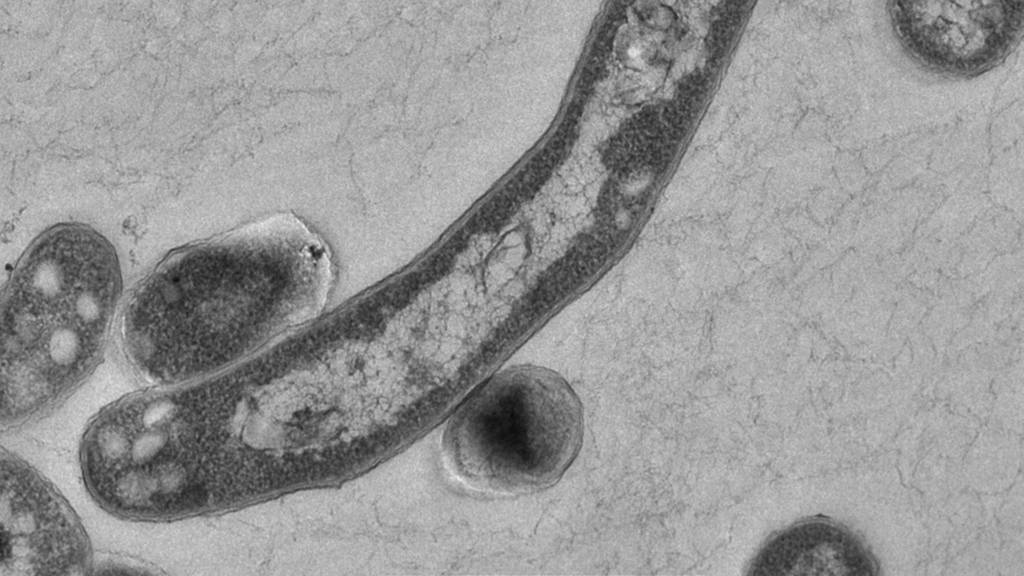 Schülerin in Suhr hat Tuberkulose