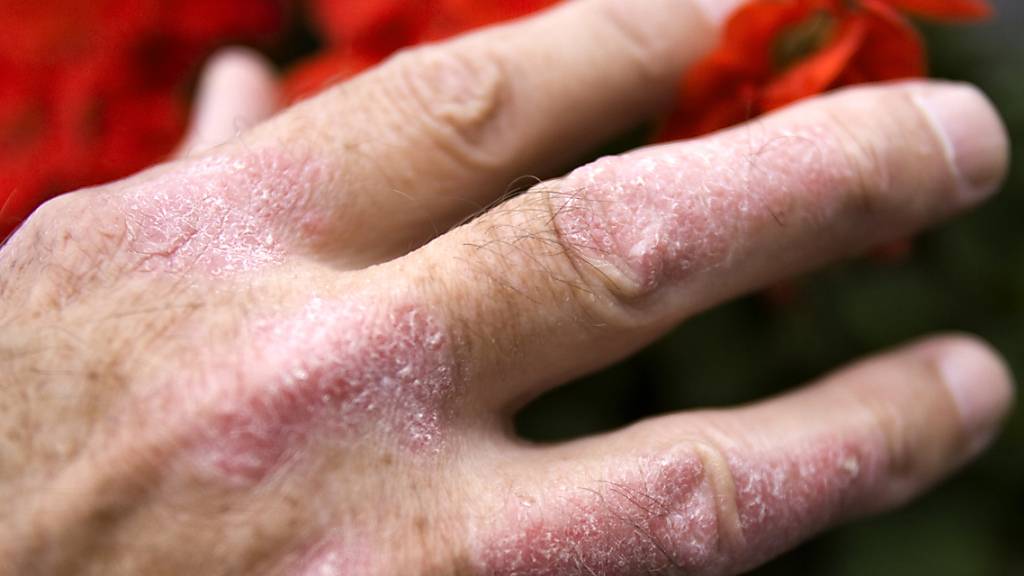 Schuppenflechte (Psoriasis) an der Hand eines Mannes: Medikamente gegen die Hautkrankheit, die den Botenstoff Interleukin-12 blockieren, sind wohl kontraproduktiv, wie eine neue Studie zeigt. (Archivbild)