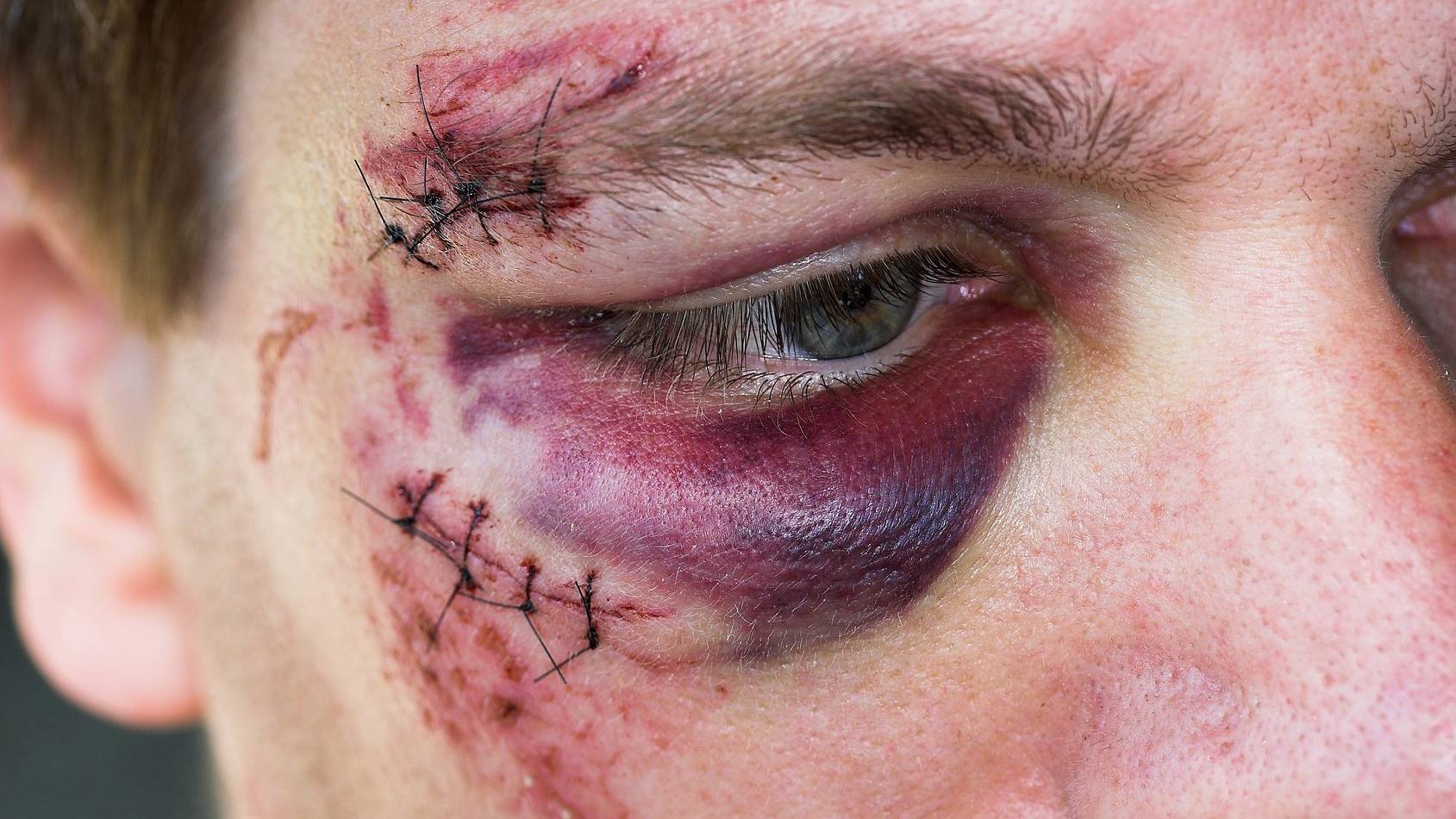 Symbolbild: Der verunfallte Velofahrer musste wegen Verletzungen im Gesicht ins Spital.