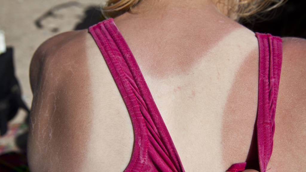 Haut vergisst nicht: UV-Strahlen richten auch bei Wolken Schaden an