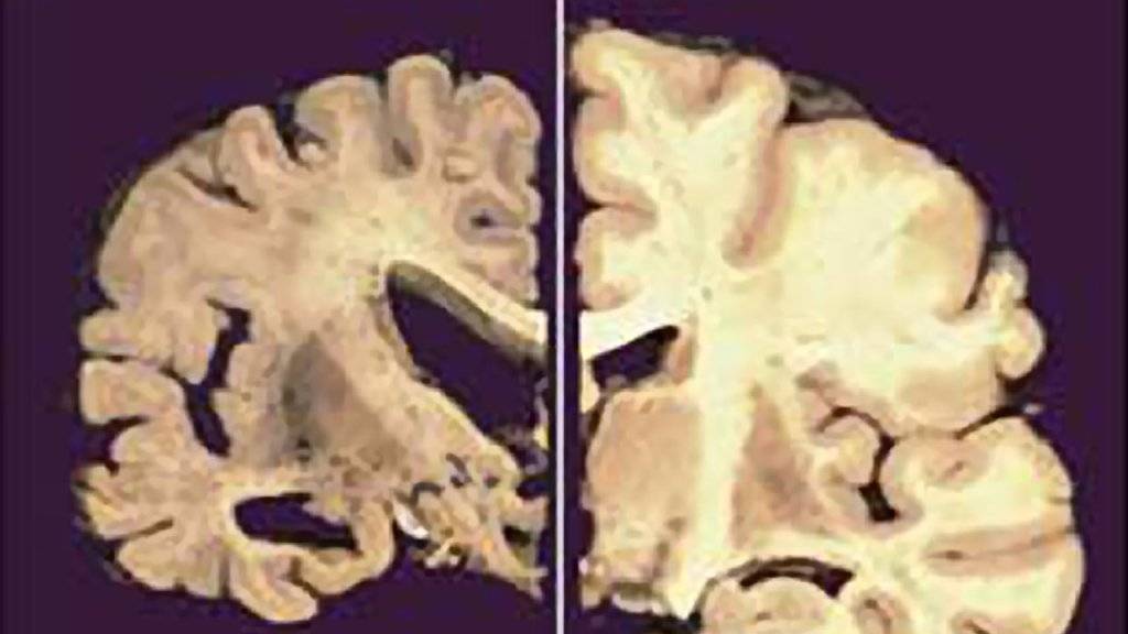 Querschnitt durch ein gesundes Gehirn (rechts) im Vergleich zu einem durch die Alzheimer-Erkrankung geschädigten Gehirn (links). (Archiv)