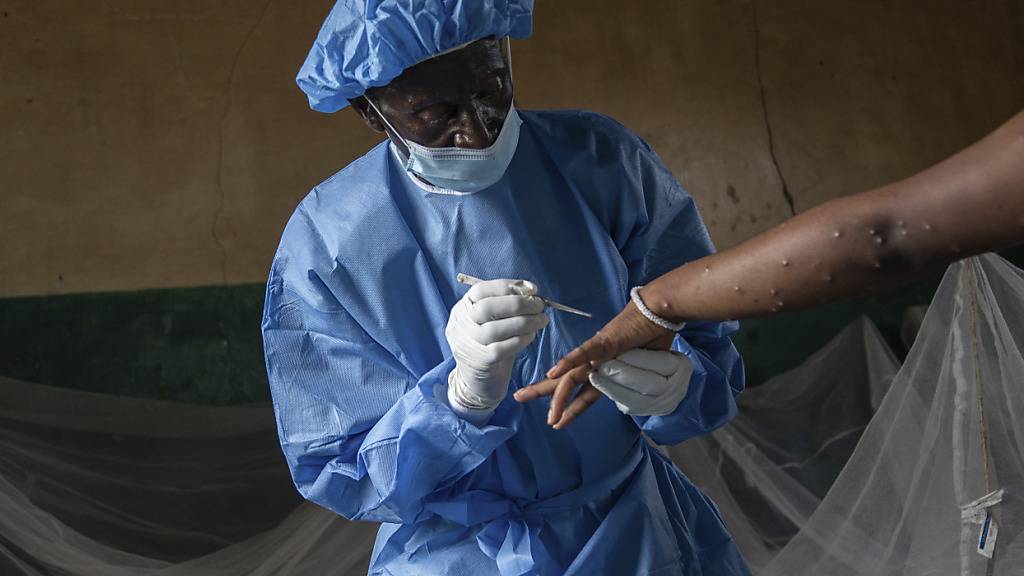 Mehr als 800 Tote durch Mpox-Virus in Afrika seit Januar