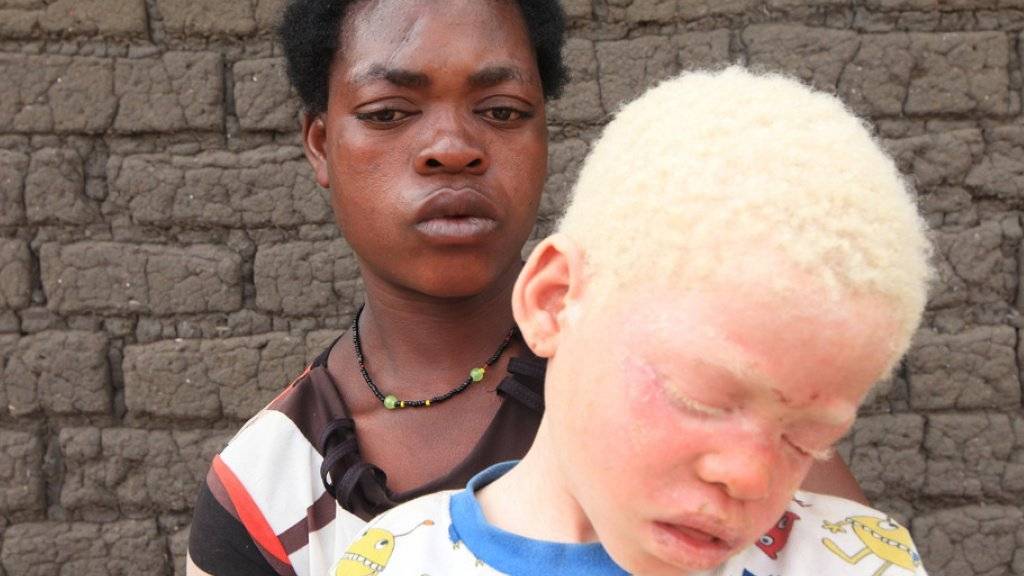 In Afrika werden Albinos vielerorts verfolgt und ermordet. Das EU-Parlament fordert die afrikanischen Staaten auf strenger dagegen vorzugehen. (Symbolbild)