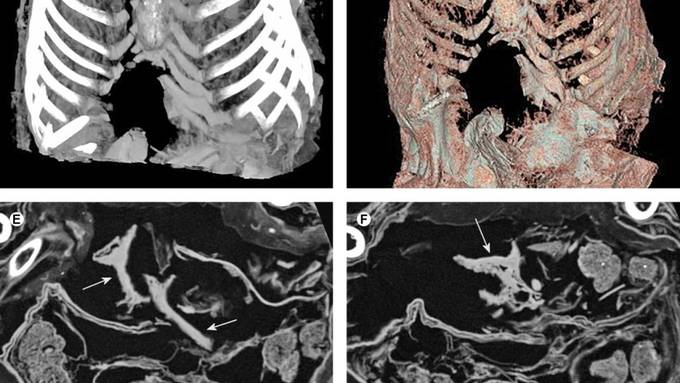 Basler Forscher enträtseln Inka-Mumie