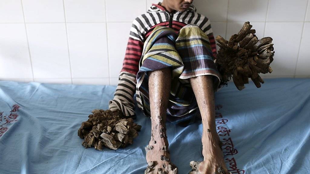 Hände und Füsse sehen aus wie Baumwurzeln: Nun wollen Ärzte dem Mann aus Bangalesch helfen.