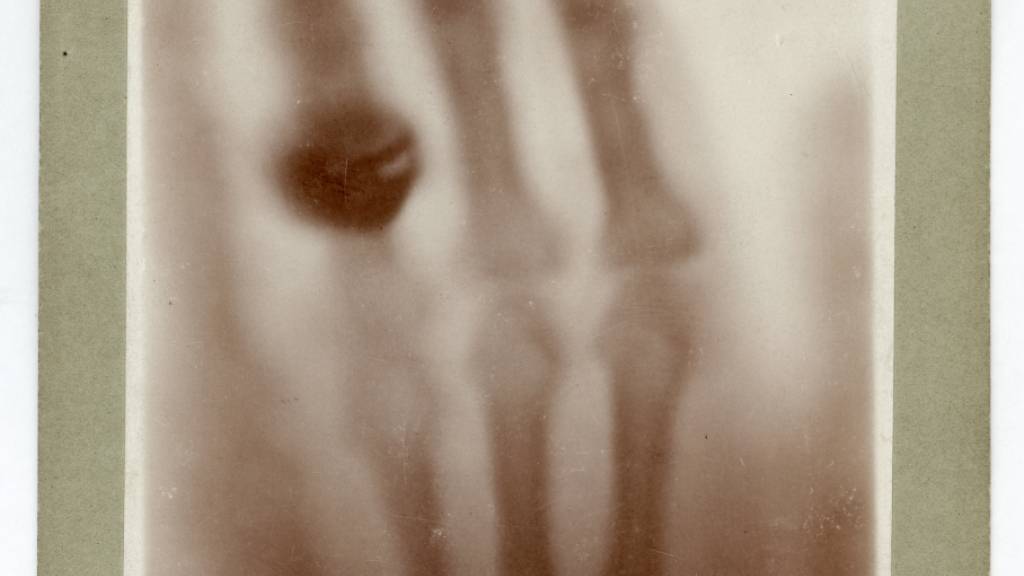 Die Hand von Anna Bertha Röntgen in einer Röntgen-Aufnahme vom 22. Dezember 1895: Das Bild zeigt ihre Handknochen mit dem Fingerring, den sie damals trug.