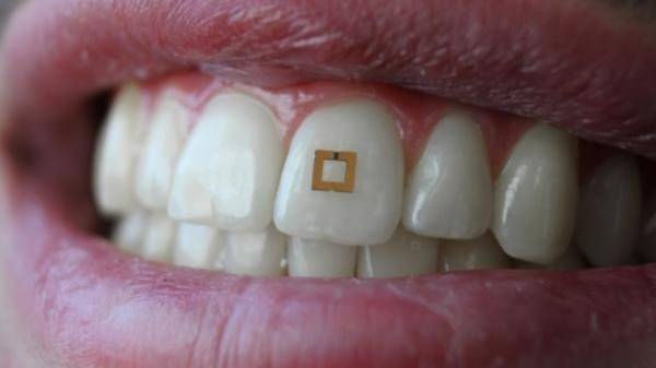 Vernetzt: Sensor auf Zahn misst Essgewohnheiten