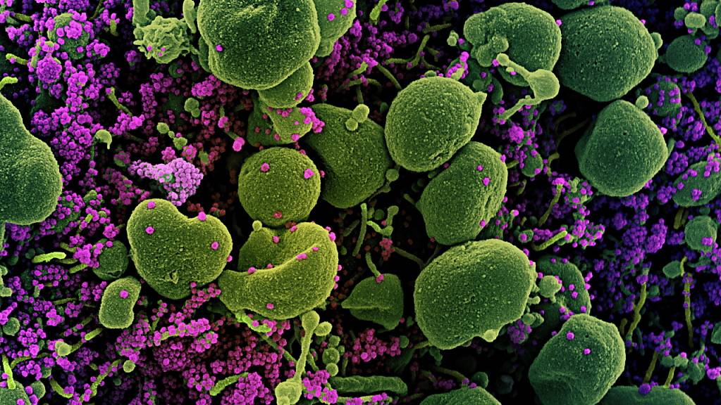 Coloriertes Bild einer von Sars-Cov-2-Erregern (violett) angegriffenen Zelle (grün) vom National Institute of Allergy and Infectious Diseases (NIAID) Integrated Research Facility (IRF) in Fort Detrick, Maryland, USA.