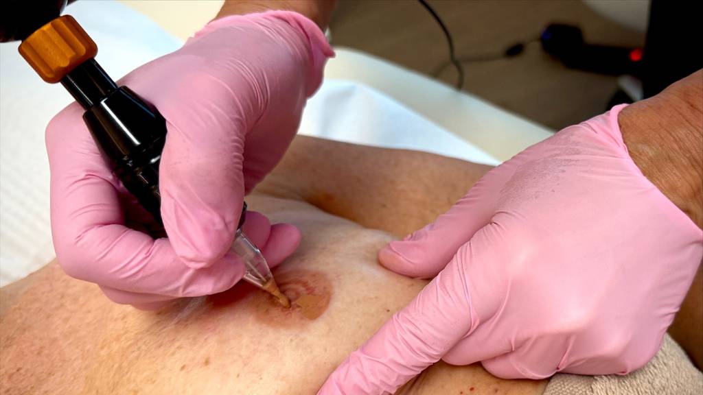 Brustwarzen-Tätowieren nach Krebsoperation