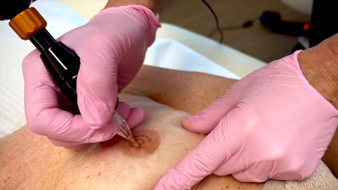 Brustwarzen-Tätowieren nach Krebsoperation