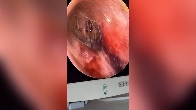 Horror-Fund beim Ohrenarzt: Mann hat Spinne im Ohr