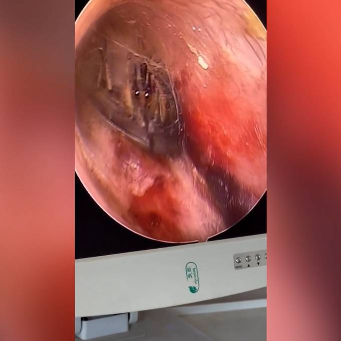 Horror-Fund beim Ohrenarzt: Mann hat Spinne im Ohr