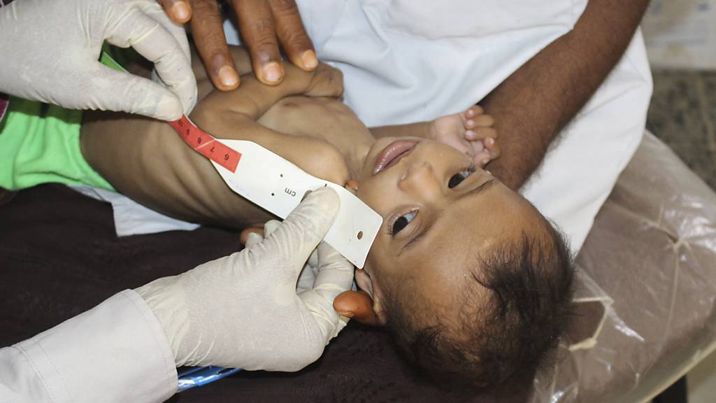 Das am 29.06.2020 zur Verfügung gestellte Foto zeigt das sieben Monate alte, unterernährte Mädchen Issa Ibrahim Nasser, die in einer Klinik gemessen wird. Mit sieben Monaten wiegt Issa nur drei Kilo. Wie sie leiden im Jemen zahlreiche Kinder aufgrund von Armut an akuter, schwerer Unterernährung. Foto: Issa Al-Rajhi/AP/dpa