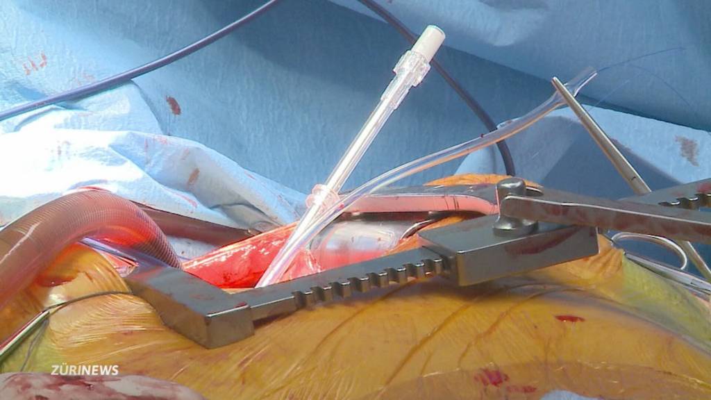 USZ-Bericht bestätigt schwere Fehler in Herzchirurgie