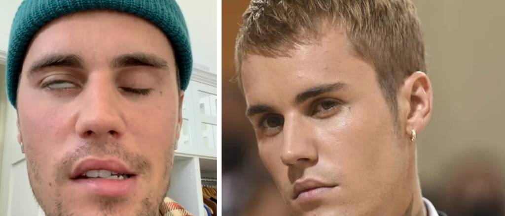Justin Bieber leidet an einer Gesichtslähmung