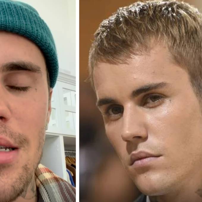 Justin Bieber leidet an einer Gesichtslähmung