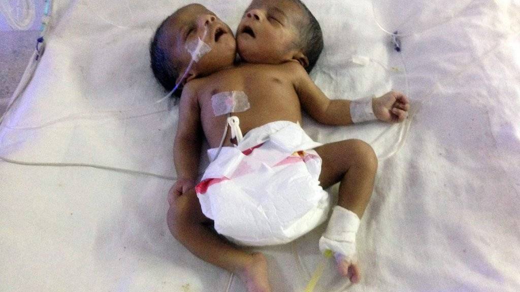 Das Mädchen - hier in der Intensivstation eines Spitals in der Hauptstadt Dhaka - wurde mit zwei Köpfen geboren
