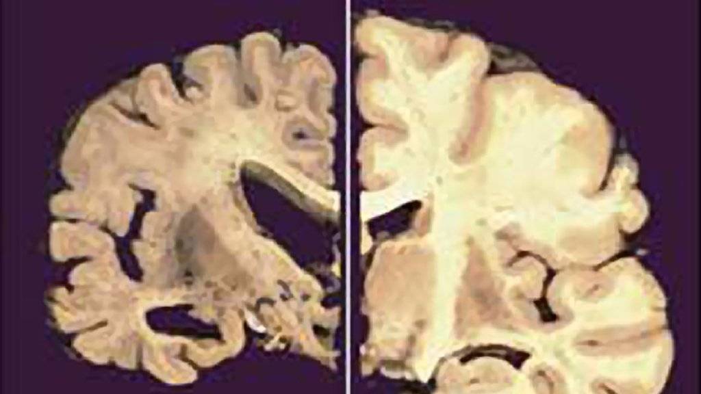 Im Gehirn eines Menschen mit Alzheimer (links): Die Grosshirnrinde schrumpft - mit drastischen Folgen für die Betroffenen. (Archivbild)