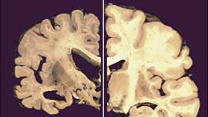 Einsatz für Therapie von Alzheimer und Demenz