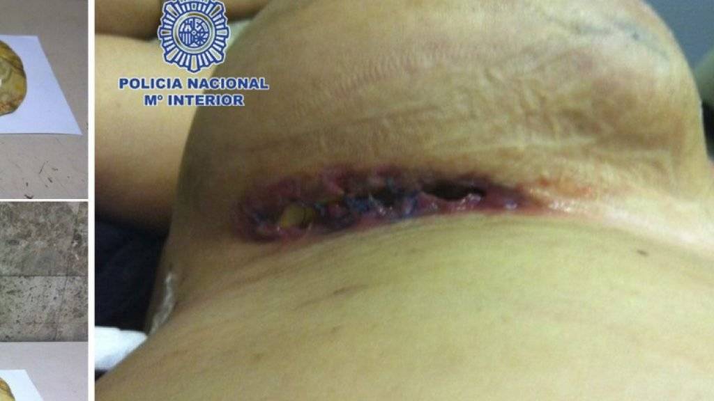 Neulich in Spanien: Polizei beschlagnahmt mit Drogen gefüllte Brustimplantate (Archiv)