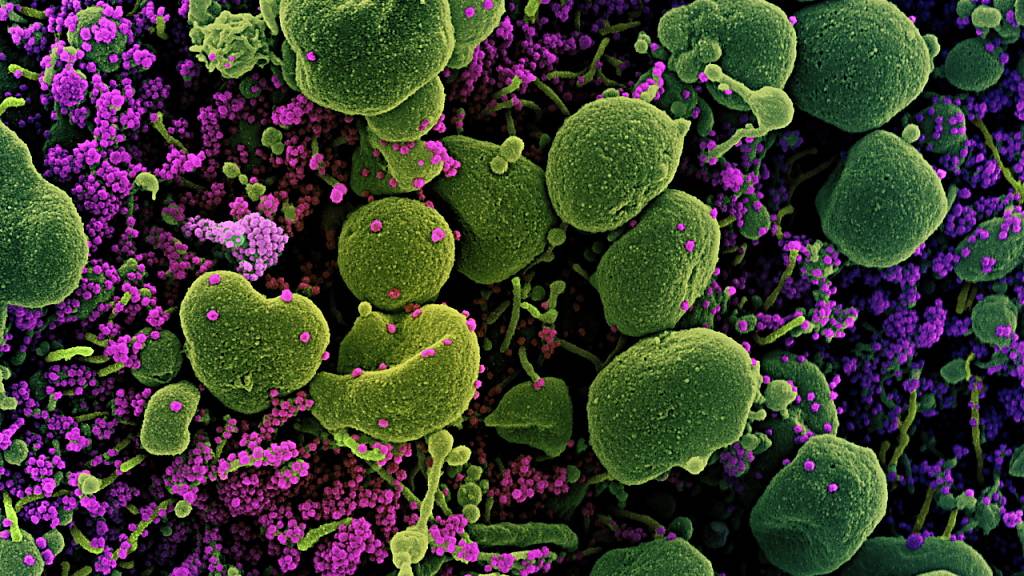 Coloriertes Bild einer von Sars-Cov-2-Erregern (violett) angegriffenen Zelle (grün) vom National Institute of Allergy and Infectious Diseases (NIAID) Integrated Research Facility (IRF) in Fort Detrick, Maryland, USA.