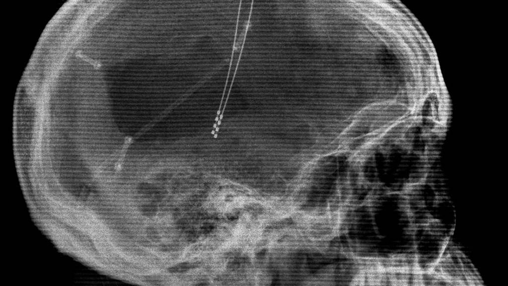Röntgenbild eines Patienten mit implantierten Elektroden zur Tiefen Hirnstimulation (Deep Brain Stimulation DBS), einer Therapieform zur Linderung von Parkinson. Der Welt-Parkinson-Tag vom kommenden Sonntag erinnert daran, dass es jede/n treffen kann und dass Früherkennung wichtig ist. (Archivbild)