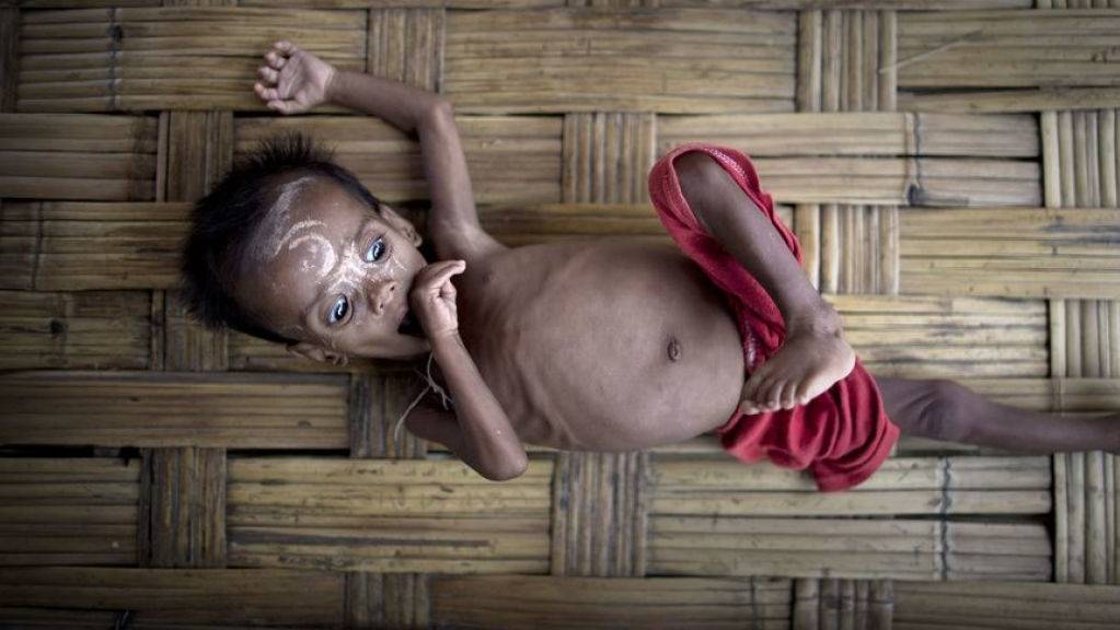 Unterernährung ist nur die halbe Bürde von armen Ländern. Die andere Hälfte ist die Überernährung bei gleichzeitigem Nährstoffmangel zum Beispiel durch minderwertige Fertigkost. (Symbolbild)