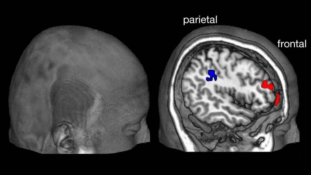 Während der Entscheidung im Hirnscanner: Je stärker die Gehirnbereiche im Parietalcortex und im Frontalcortex kommunizierten während die Testpersonen in ihrer Entscheidungsfreiheit eingeschränkt wurden, desto stärker war das Trotzverhalten.