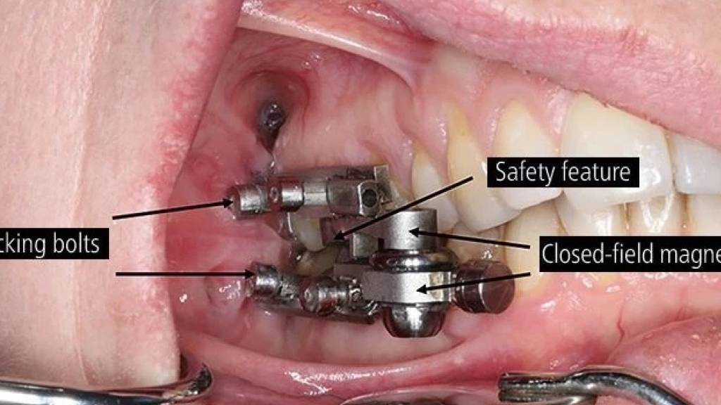 Wer abnehmen will, muss die Zähne zusammenbeissen. Mangelt es dafür an Disziplin, kann die magnetische Kiefersperre (Bild) helfen, die neuseeländische Forscher entwickelt haben (Pressebild).