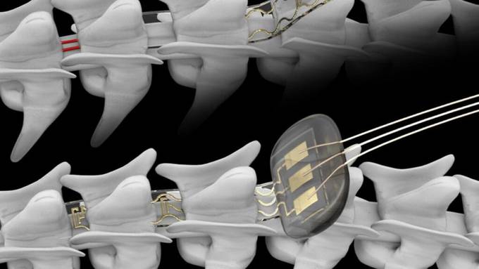 EPFL-Forscher entwickeln Implantat zur Steuerung von Nervenzellen