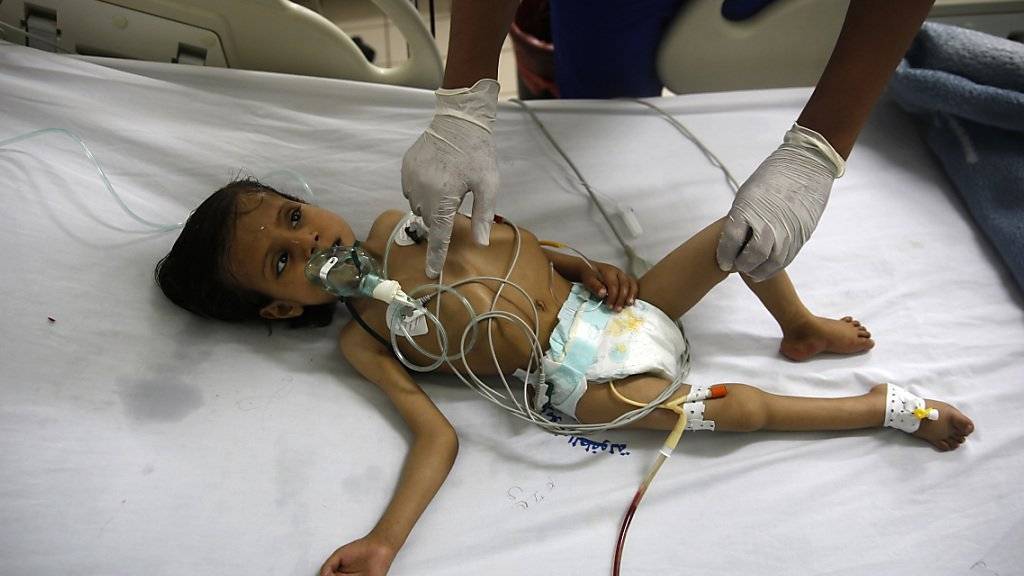 Unterernährtes Kind in Sanaa, Jemen: Nach Schätzungen von UNICEF sind im Jemen inzwischen zehn Millionen Kinder auf humanitäre Hilfe angewiesen.