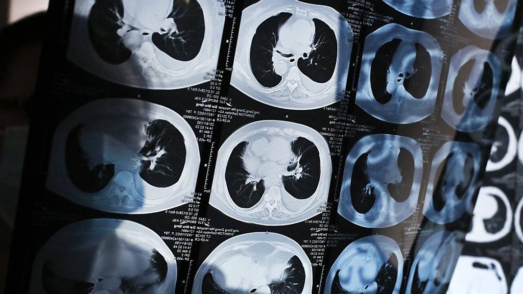 Ein Blick auf die Lunge: Frau in Kanada überlebt sechs Tage ohne das Organ. (Symbolbild)