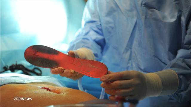 Arzt vergisst 28 cm lange Metallplatte im Körper