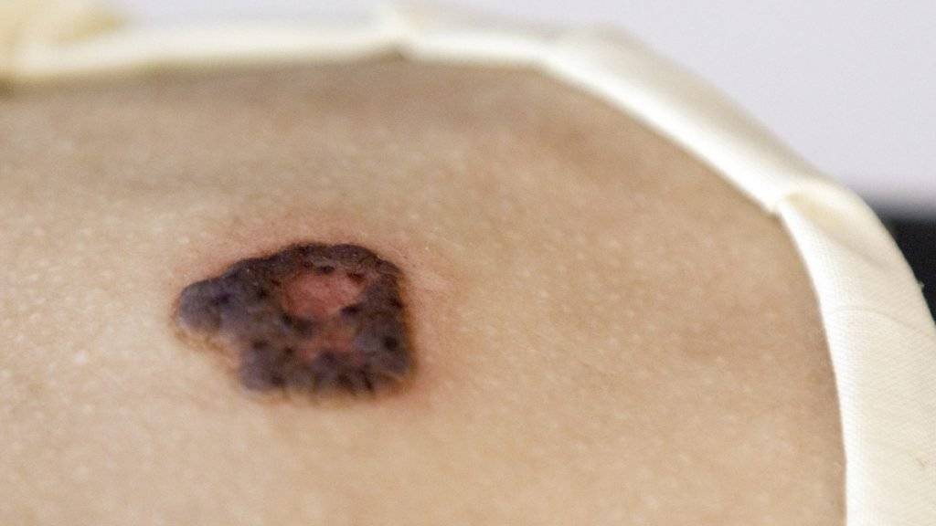 Eine Moulage eines pigmentierten Basalioms. Laut einer Studie könnte Künstliche Intelligenz bei der Diagnose von Hautkrebs künftig eine wichtige Rolle spielen. (Archivbild)