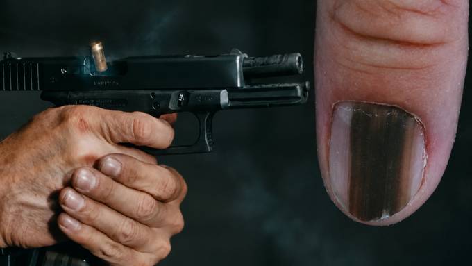 Nach Pistolenschuss: Schwarzer Hautkrebs bleibt unerkannt